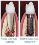 Implantes Dentales | Protesis sobre Implantes