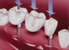 Puente sobre Implantes Dentales