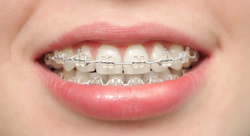 Implantes Dentales | Protesis sobre Implantes